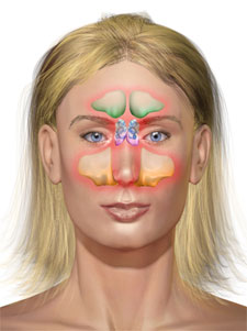 sinisitis home remedies