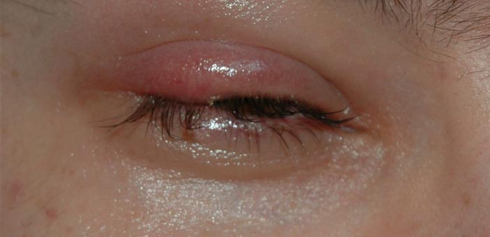 eye stye