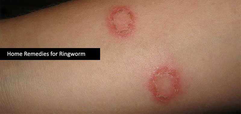 how to cure a ringworm on skin